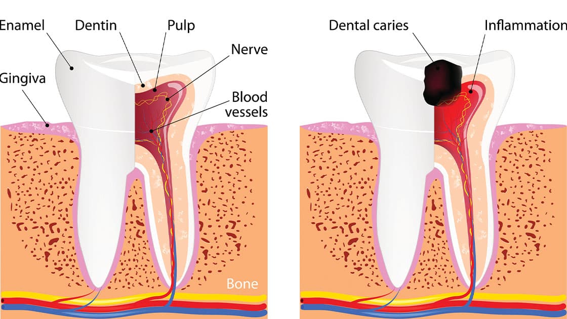 Root canal photo