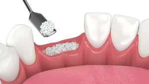 Bone graft